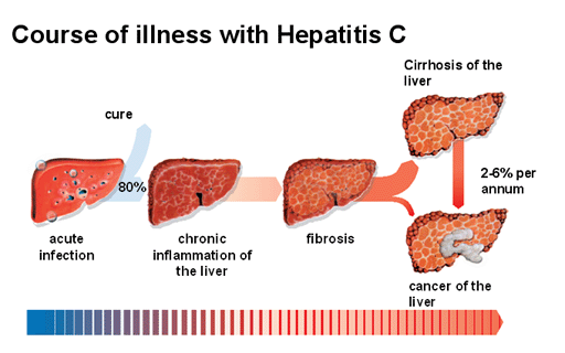 hepatitis-c-disease