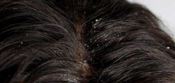 What is Dandruff? Its causes & natural remedies - Natural Energy Hub