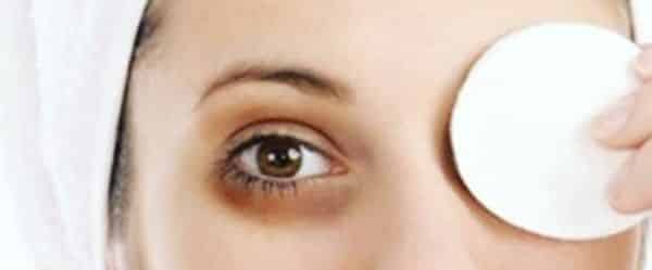 eyes dark circles causes and natural remedies